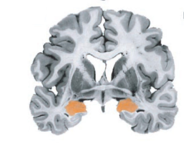 Image of activated amygdala from Richard Davidson